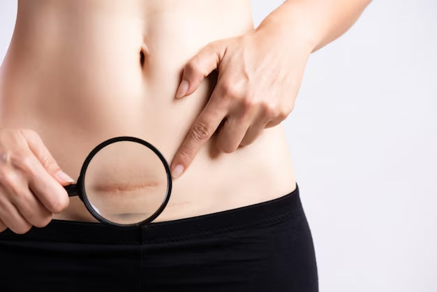 How To Make Scars Go Away